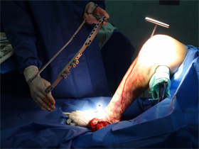 Surgery photo of a leg and some metal components
